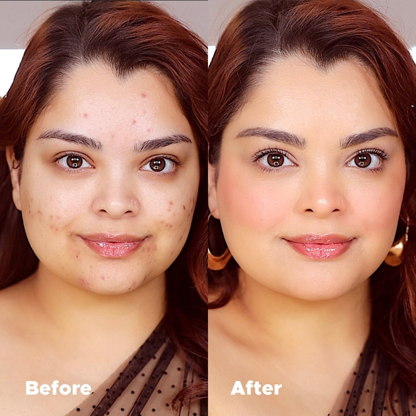 Universal Foundation Vorher-Nachher-Vergleich, der Akne und Rötungen für ein natürliches, mattes Finish abdeckt